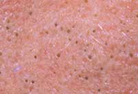 Example of blackheads