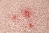 Example of pimples