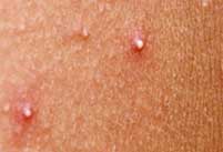 Example of whiteheads